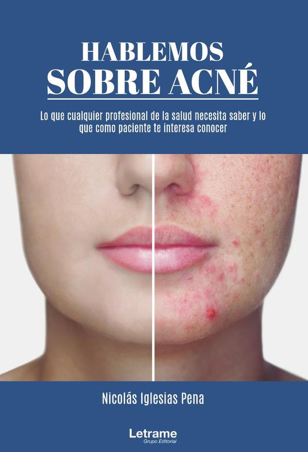 Hablemos sobre acné